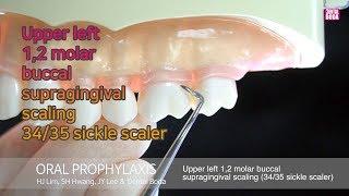 Upper left 1,2 molar buccal supragingival scaling 34/35 sickle scaler