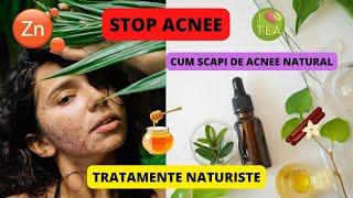 Stop acnee, tratamente naturiste, alimentație sănătoasă, stop cosuri pe față