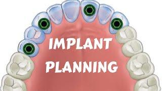 Dental Implant Lecture | Implant Treatment Planning | Key Implant position I Edentulous Arch