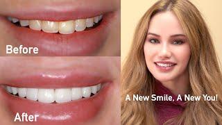 Veneers and Crowns - Stunning Smile Enhancement - Live Cosmetic Dentistry