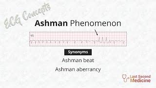 Ashman phenomenon | Ashman Beat | Ashman Aberrancy