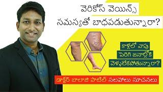 Live Session with Dr Balaji Patel Kola About Varicose Veins: Causes and Laser Treatment