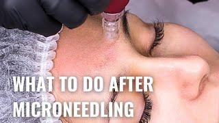 Microneedling Aftercare - Do's and Don'ts for Best Results