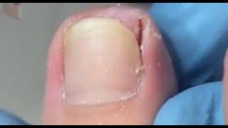 Huge Dimple After Repairing Toenail