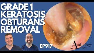 GRADE 1 KERATOSIS OBTURANS REMOVAL - EP917