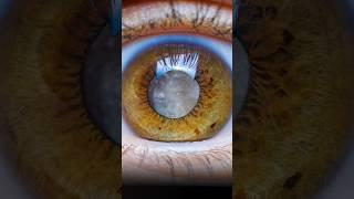 Animation - how Eye Cataract surgery is done #shorts #cataract #eyes