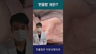 표피낭종 핀홀법이란?! (피지낭종 수술 흉터)[아문TV]