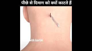 Brain Tumor को कैसे निकाला जाता है?  #shorts #viralshorts #trending #shortvideo #youtubeshorts