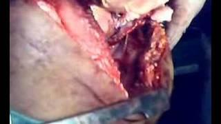 REPAIR OF STAB INJURY OF HEART