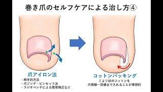 巻き爪の治し方・自分でコットンで治す方法は？｜大木皮膚科