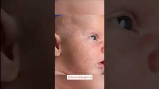 Common skin concerns of babies #skinconcerns #babyskin #babyskincareproducts #skincare