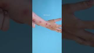 ATTN:  Monkeypox outbreaks have been on the rise