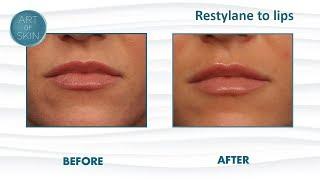 Perfect lips:  Filler Restylane to lips with cannula Dr. Melanie Palm Art of Skin MD San Diego CA