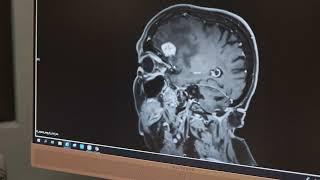 Brain Tumor Treatment Without a Scalpel at Acıbadem, Türkiye