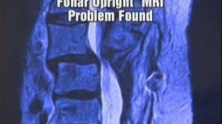 Fonar Case Study: Severe Spondylolisthesis Undetected by Recumbent MRI