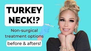 TURKEY NECK!? How to tighten saggy neck skin, tech neck, non surgical options!