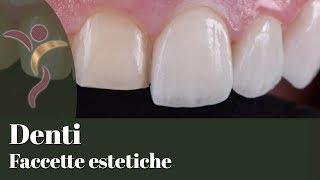 Faccette estetiche - Medicina estetica Dr. Mariateresa Grecchi