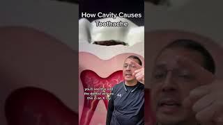 How Tooth Decay (Cavities) Leads to Toothache EXPLAINED ) | In Office to Hands On Dental Training