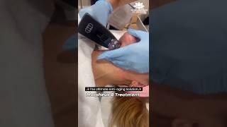 Morpheus 8 for neck | Morpheus 8 treatment | #antiaging #aging #shortviral #shortsfeed #skincare