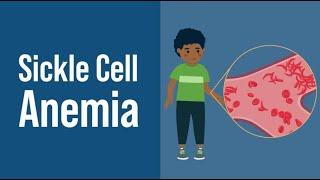 Sickle Cell Anemia