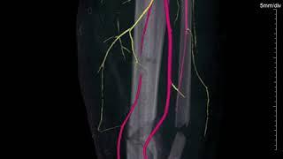 Traumatic vascular injury.