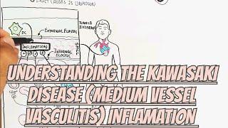 Understanding The Kawasaki Disease(Medium Vessel Vasculitis)Inflamation