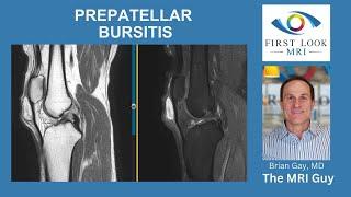 Prepatellar Bursitis