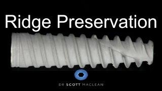 Ridge Preservation Technique - Creos Bone Grafting - Dental Implant