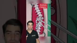 Scoliosis Surgery