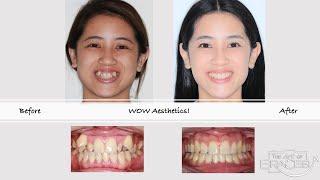 Severe dental crowding corrected with braces and extractions in 28 months