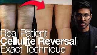 Cellulite: The ONLY Medically Licensed Reversal In The World