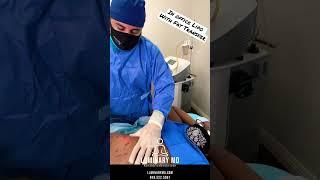 In office liposuction with Fat transfer using Beautifill with Dr. Milanes, MD in Orange County