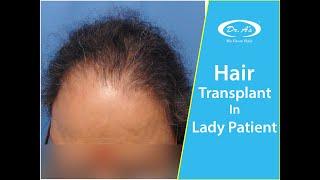 Hair Transplant In Lady Patient @ Dr. A's Clinic