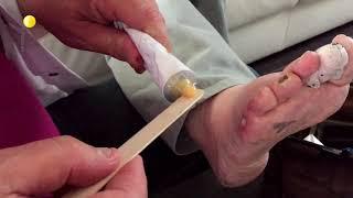 Medical Grade Honey on a chronic foot wound