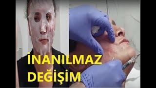 YÜZ DOLGUSU İLE DÜNYA GÜZELİ OLDU