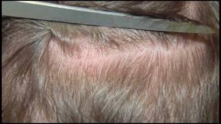 Przeszczep włosów metodą FUE (Follicular Units Extraction)