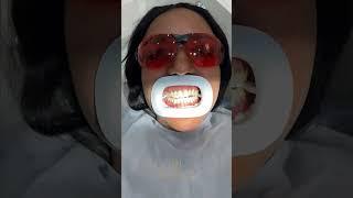 Teeth whitening process