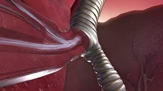 The Mechanics of an Asthma Attack. An Animated Insight