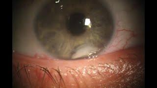 1 Slide in 5 Minutes: Lens Particle Glaucoma (Malik Y. Kahook, MD)