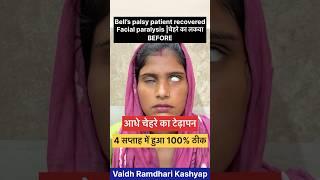 Bell’s palsy patient recovered || #bellspalsy #sleepparalysis #facialnervepalsy #paralysis #लकवा !!