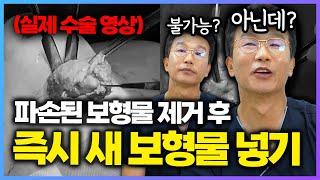 파손된 가슴 보형물 제거 후 즉시 재수술 하는 방법‍️ (파손 보형물 제거 후 재수술 1편)