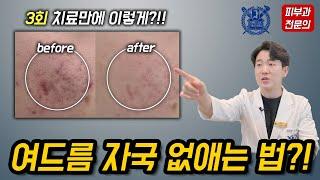 여드름 자국 없애는 법 알려드립니다~ 빠르게 여드름 치료 가능합니다~ /여드름/여드름흉터/여드름자국/여드름