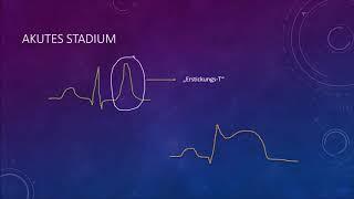 EKG Crashkurs, Teil 5: Herzinfarkt