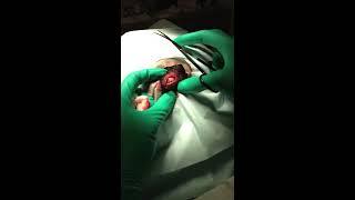 Pilar Cyst Excision