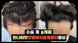 #모발이식후기  수술 후 8개월 후두부 영상 I 한나이브성형외과