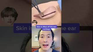 Watch How Ear Pinning (Otoplasty) Surgery Works! #shorts #otoplasty