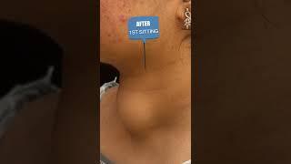 Thyroid Nodule Ablation Journey: From First Sitting to 3-Month Results | Dr. Parul Garg