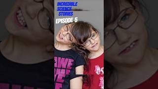 The Twins Who Shared a Brain:Tatiana and Krista Hogan's Incredible Story#IncredibleScientificStories