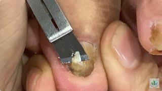 How To Cut Thick Toenails (Easy!)