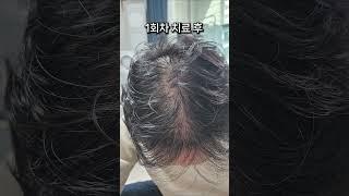 두피 주사 치료 엑소좀 12주차 결과는?? 모바른의원 한상보 두피치료 과정을 공개합니다.